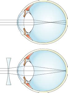 myopia wikipedia.